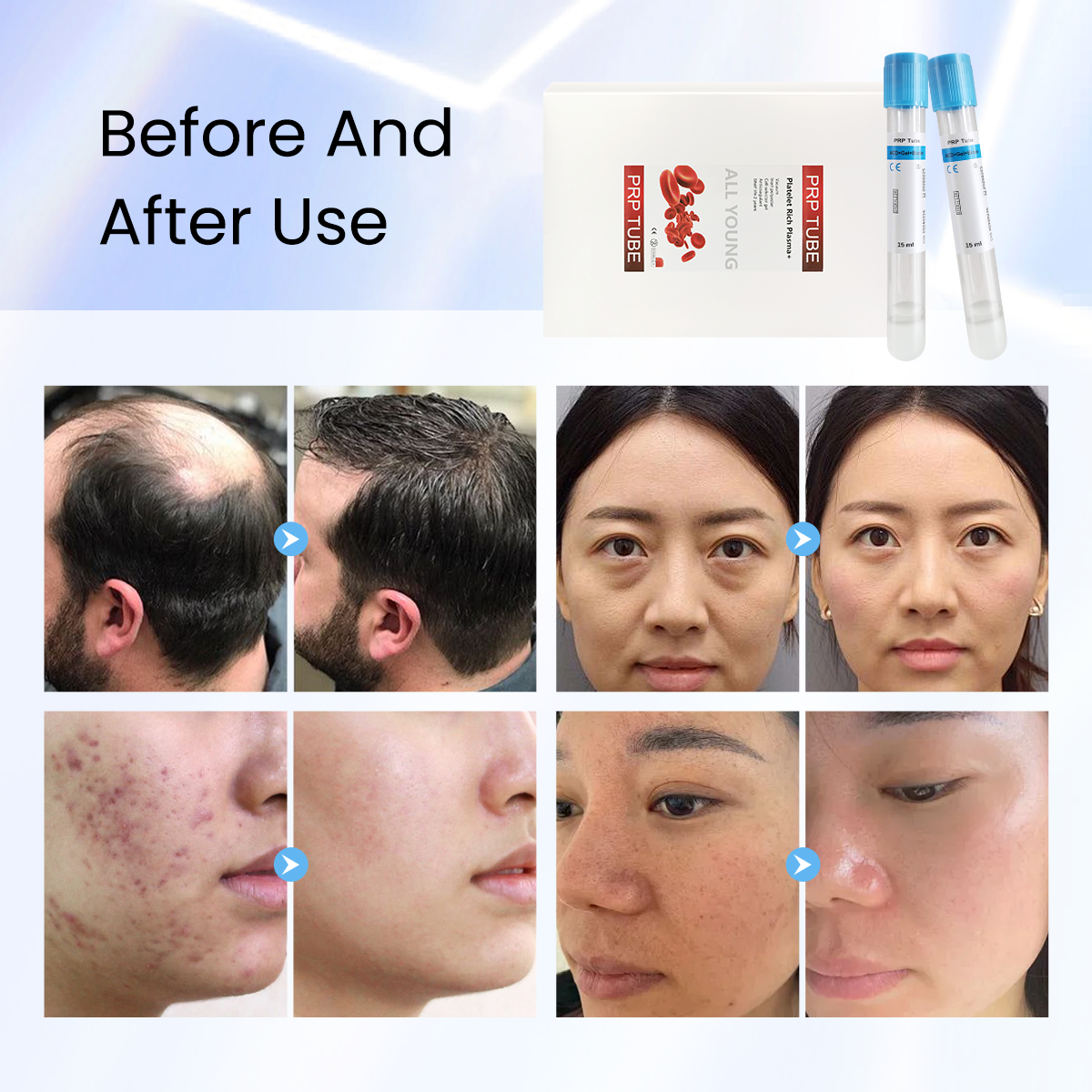 Professional PRP Kit ACD+Gel +Biotin 15ml PRP Tube and Syring Needle Set