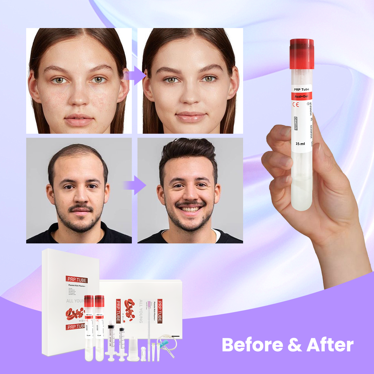 Complete PRP Kit ACD+GEL PRP Tube and Needle Syringe