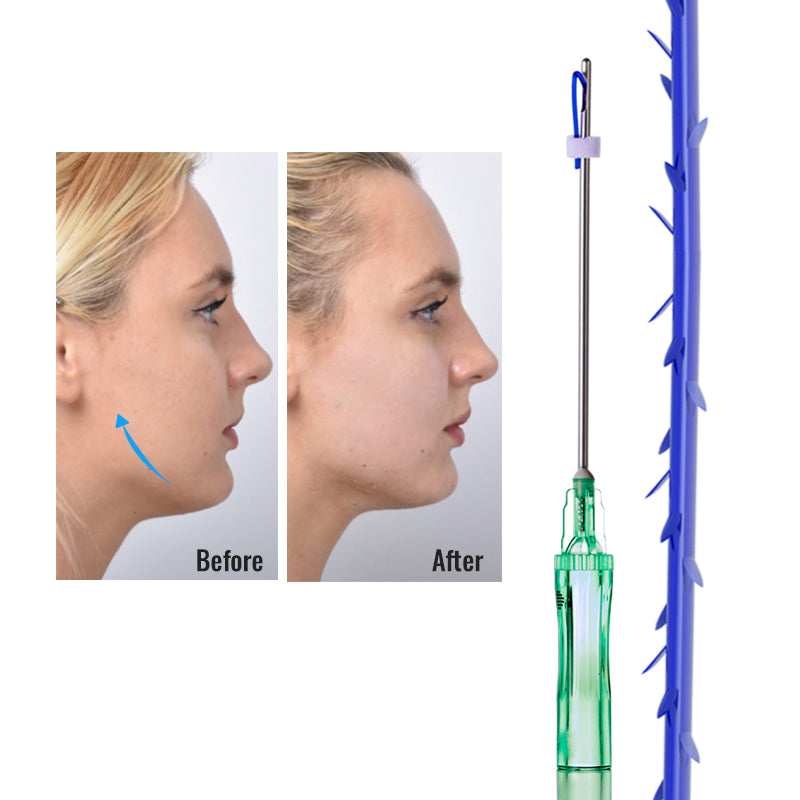 D.SEAHORSE PDO/PCL smooth and cog Threads for neck lifting fills fine lines