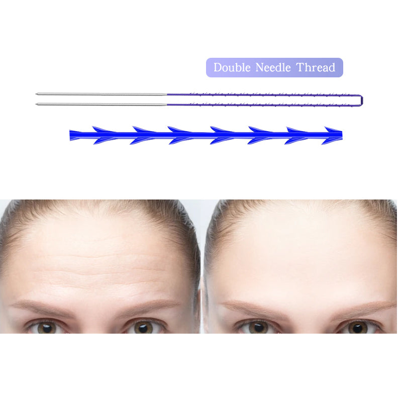 PDO Double Needle Thread for Jawline Chin Forhead Eyebrow Lifting